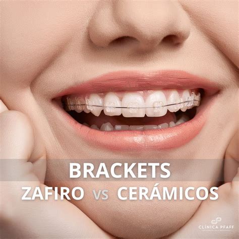 diferencia entre brackets de zafiro y metalicos|brackets linguales precio.